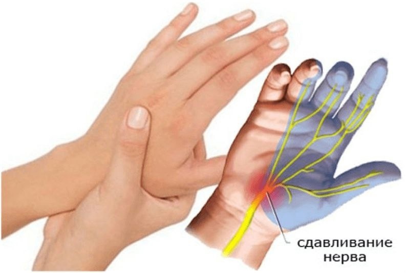 Если у вас немеют руки.