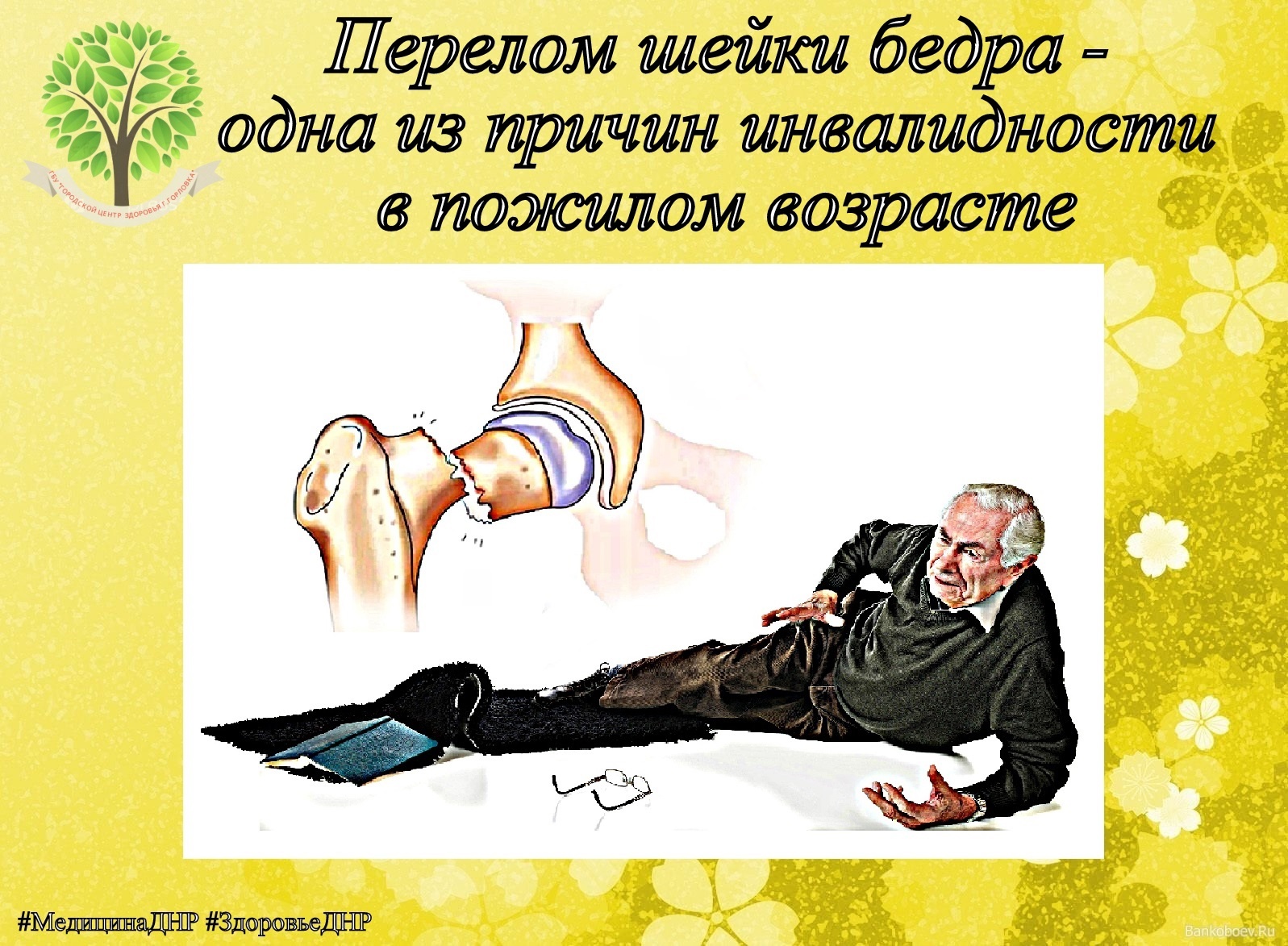 Перелом шейки бедра.