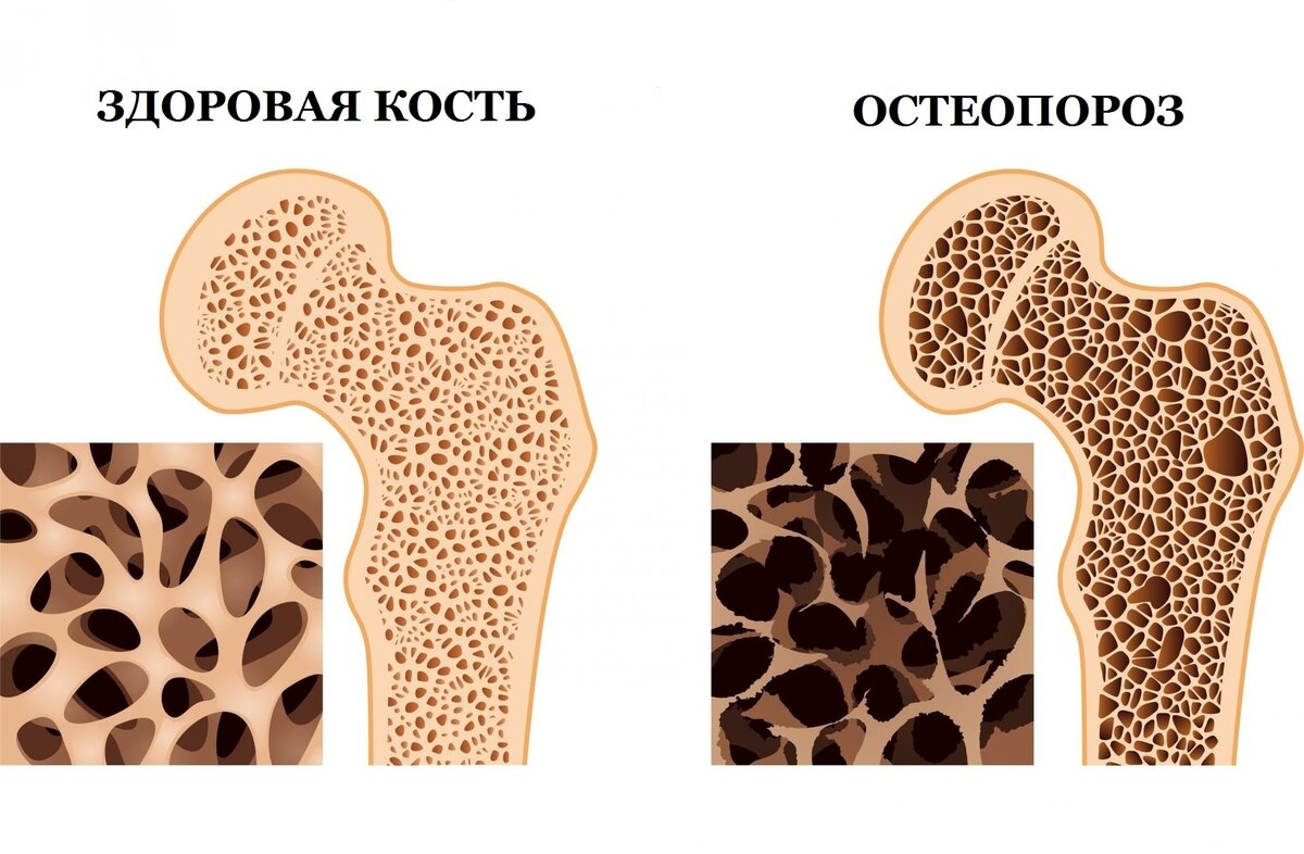 Принципы питания для профилактики остеопороза.